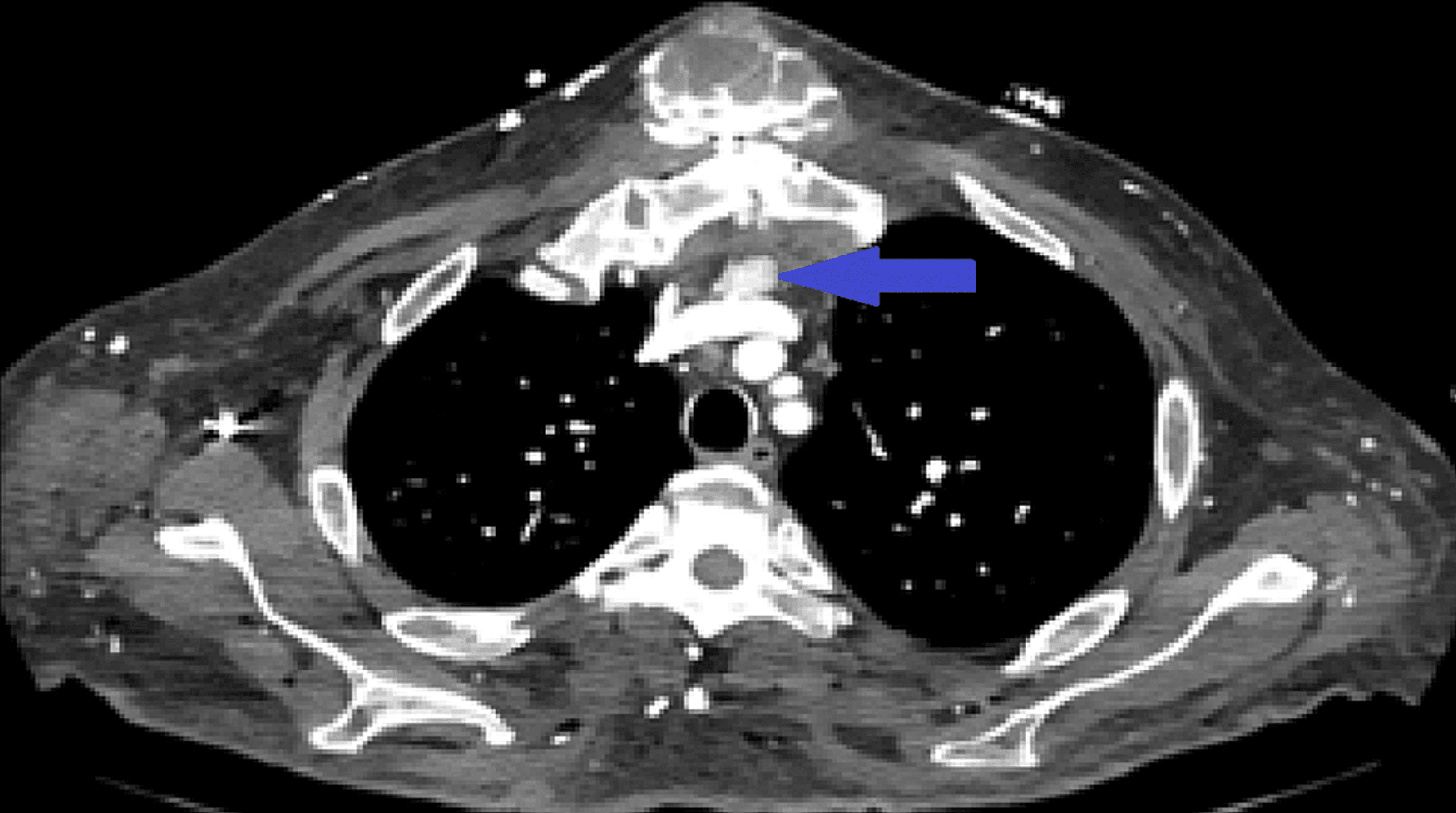 Cureus | Incidental Finding of Secondary Tumoral Calcinosis Following ...