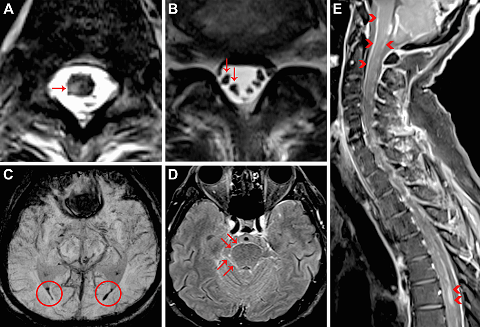 Neuroimaging-features-of-zoster-myelitis-and-hemorrhagic-meningitis.
