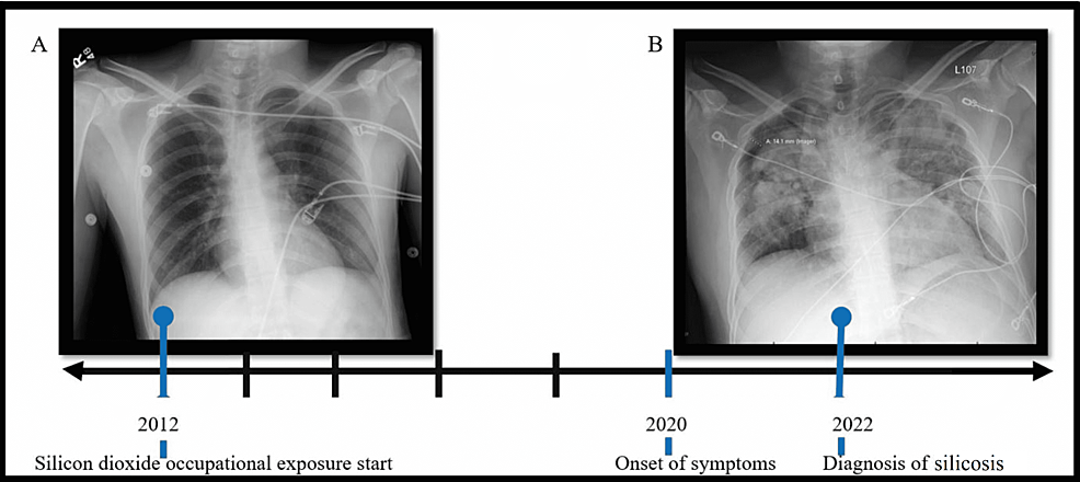 Chest-x-ray-transition-regarding-accelerated-silicosis.