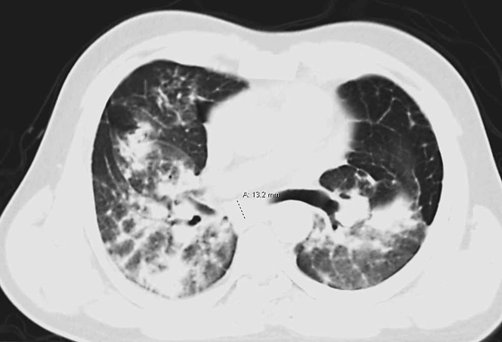Chest-CT-without-(w/o)-contrast-in-the-context-of-silicosis.