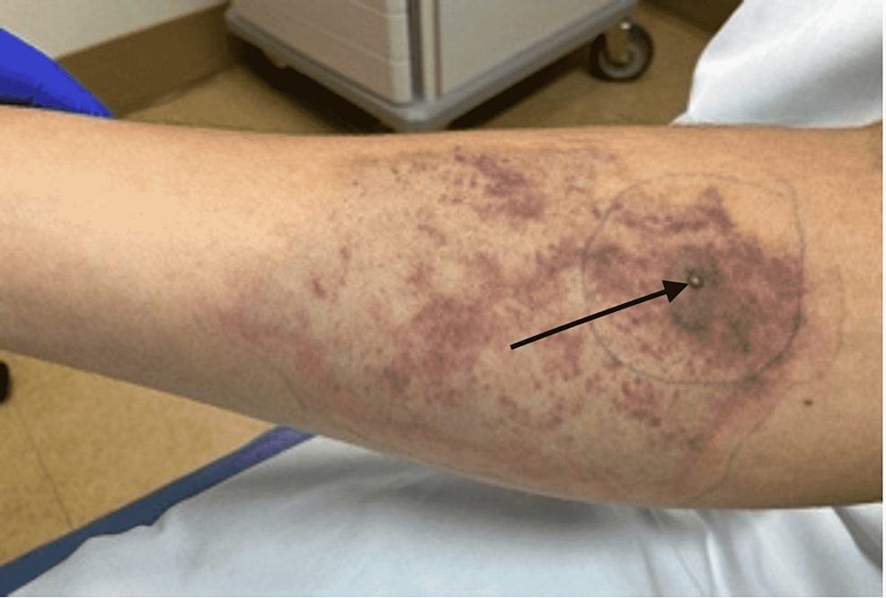 Cureus, Brown Recluse Spider Bite Resulting in Coombs Negative Hemolytic  Anemia in a Young Male Requiring Blood Transfusion