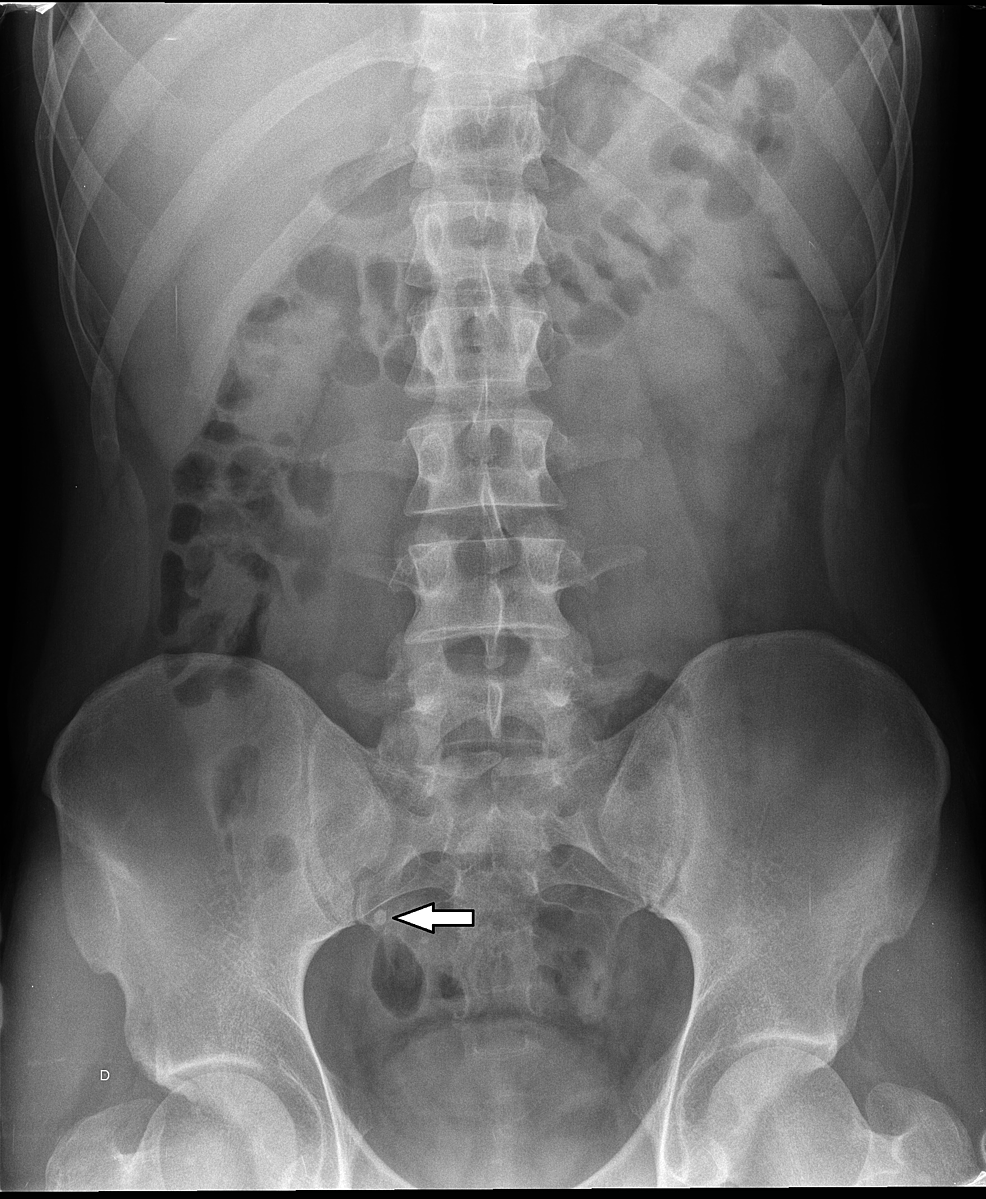 Cureus Haemangiomas of the Small Intestine Poorly Known Cause of