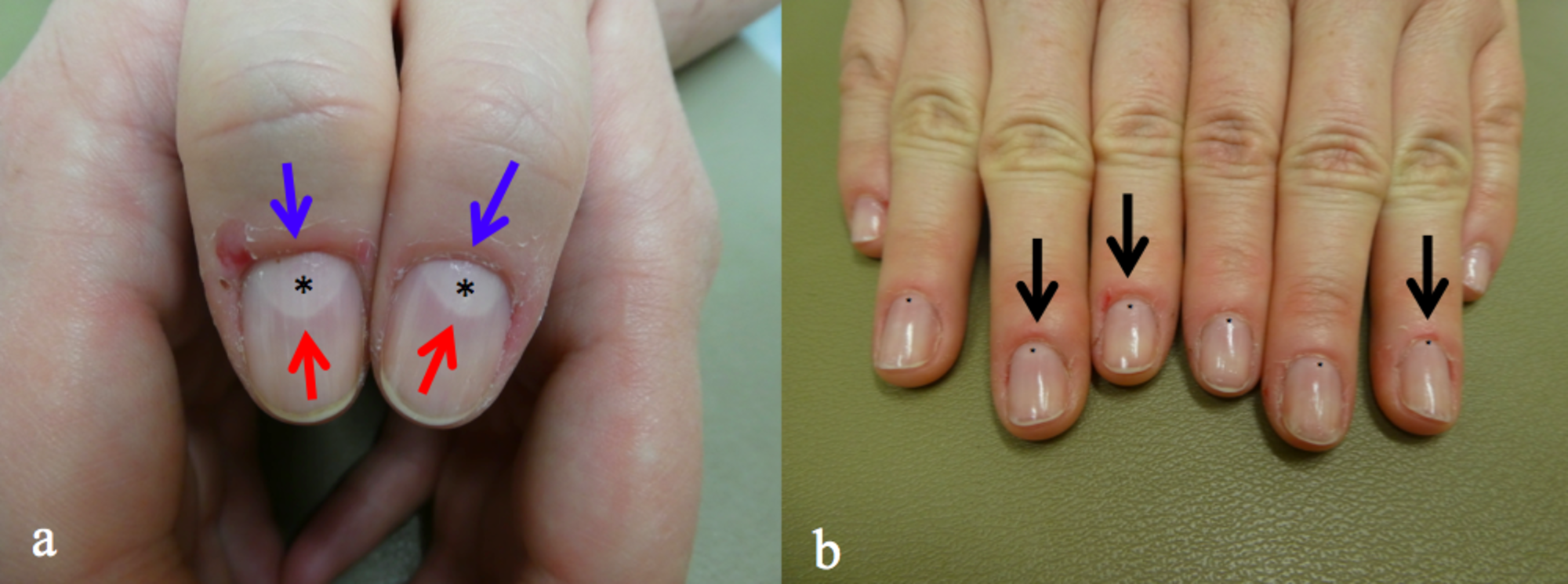 Cureus | Macrolunula: Case Reports of Patients with Trauma-associated  Enlarged Lunula and a Concise Review of this Nail Finding | Article