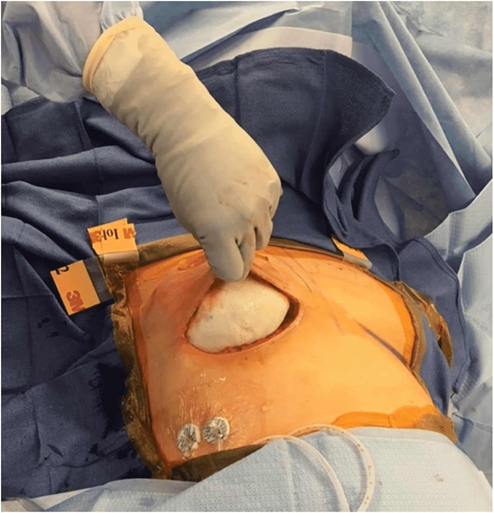 AAPS - Autologous Breast Augmentation With Incision Free Flaps