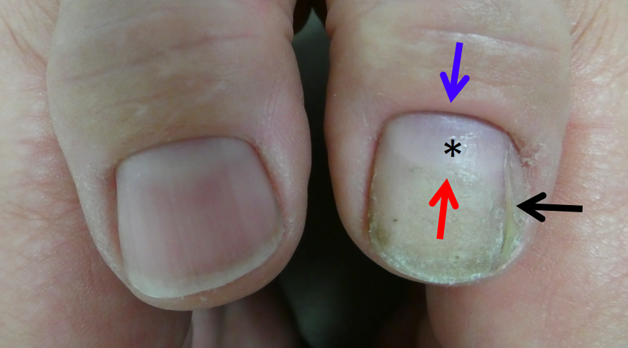 Cureus | Macrolunula: Case Reports of Patients with Trauma-associated  Enlarged Lunula and a Concise Review of this Nail Finding | Article
