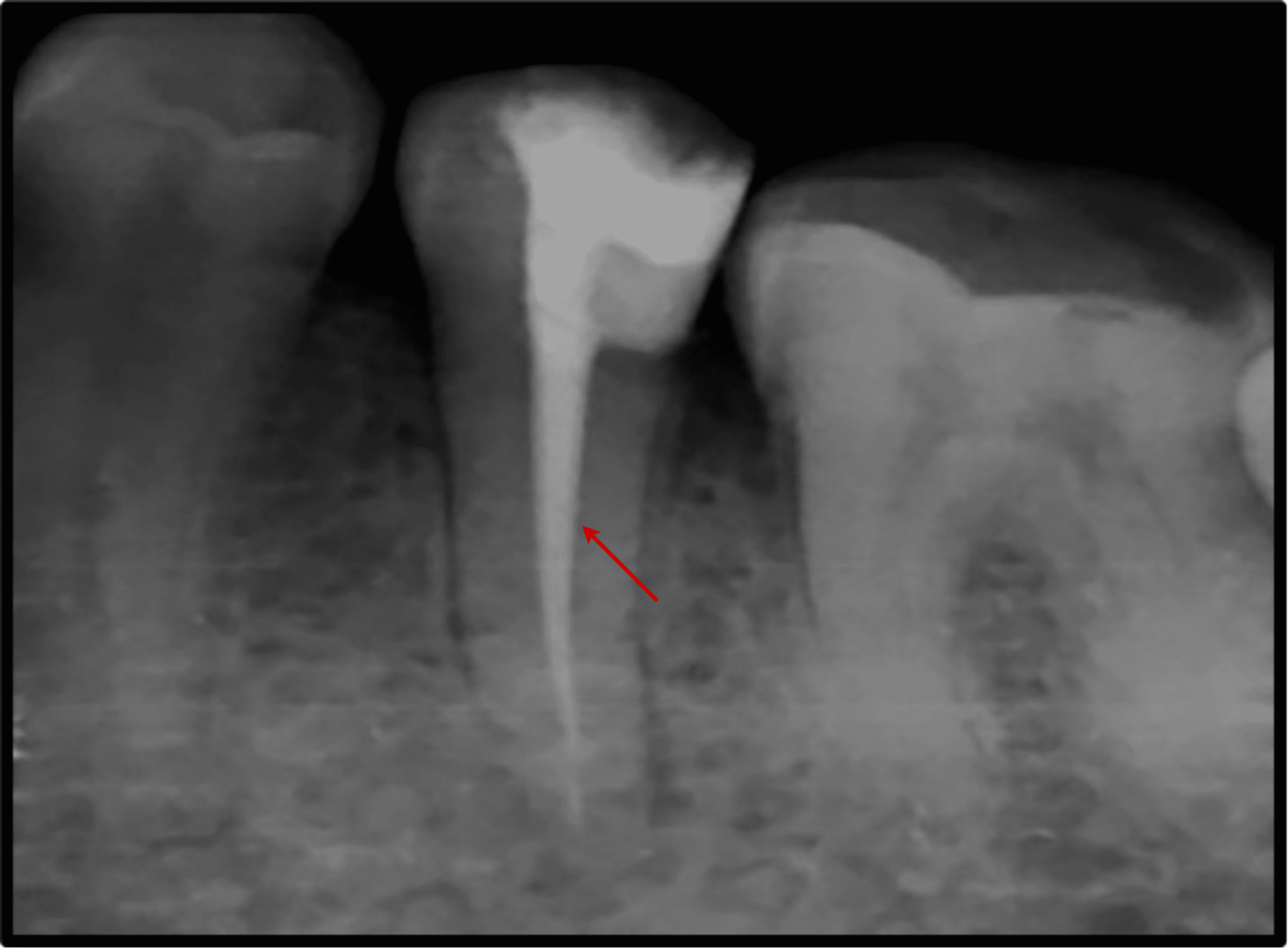 Cureus The Hidden Anatomy of a Lower Premolar With Two Canals