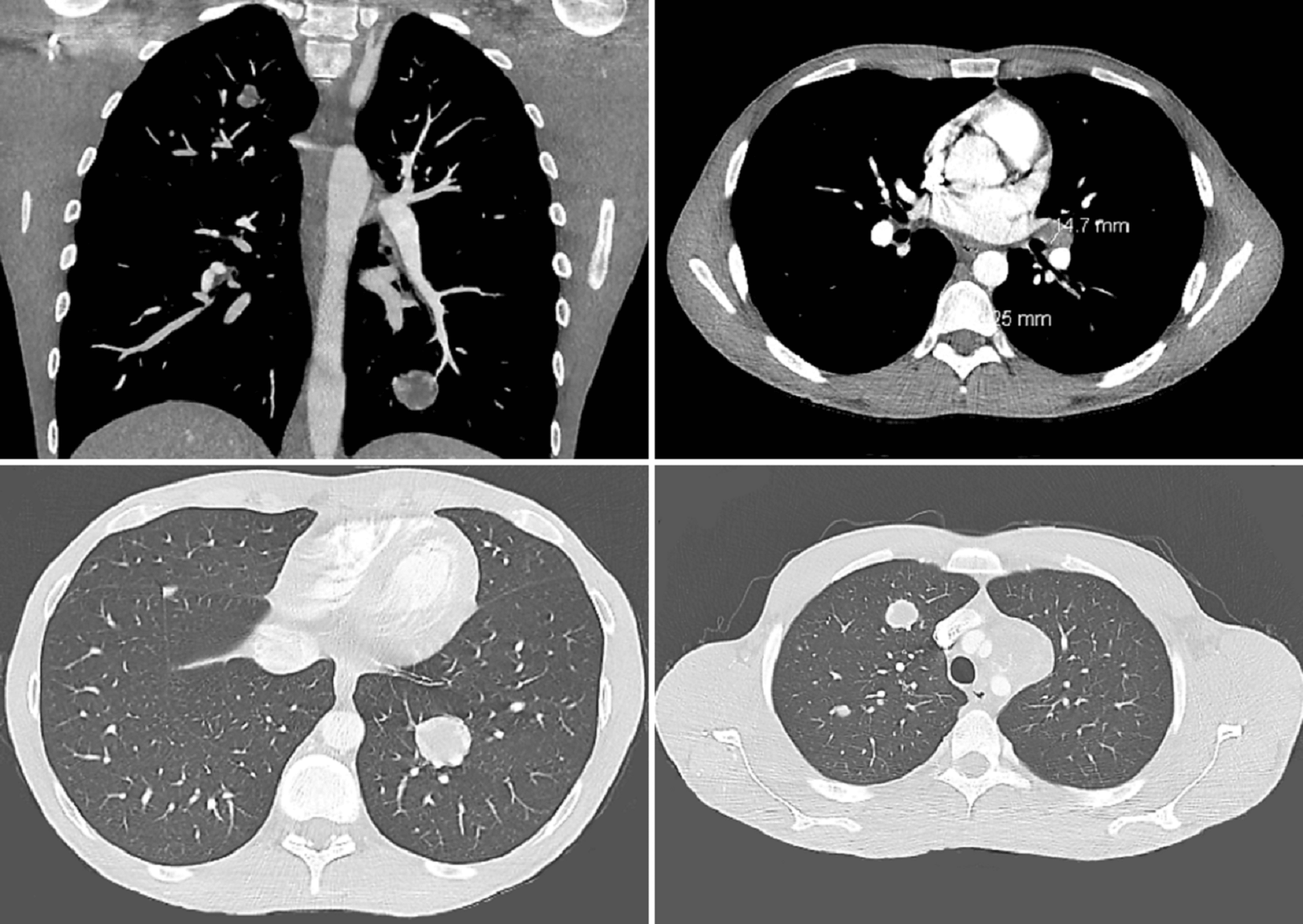 Cureus Burned Out Testicular Germ Cell Tumor Presenting As Retroperitoneal Lymphadenopathy In 9867