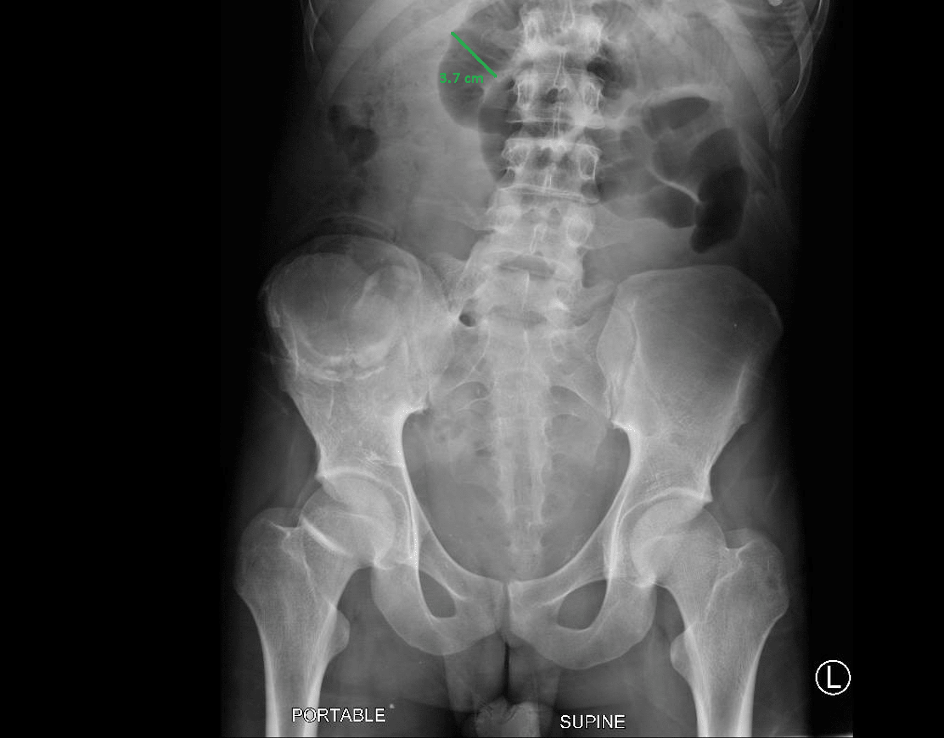 Cureus | Distal Intestinal Obstruction Syndrome Relieved by Ileoscopy ...