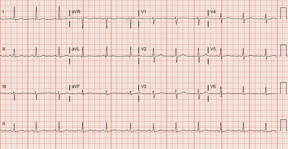 Cureus | Living on a Thread: A Case of Critical Left Main Coronary ...