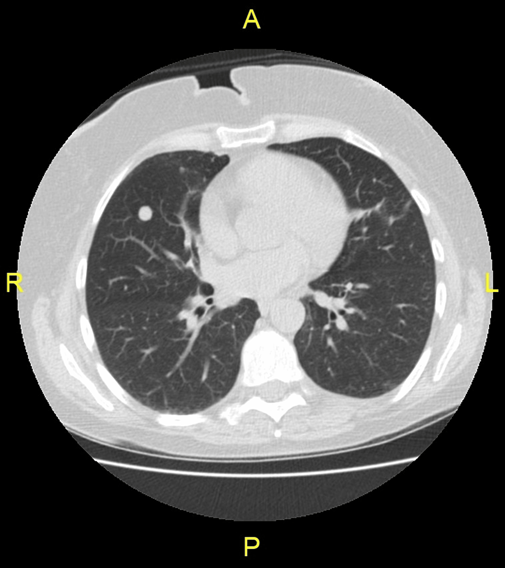 Chest-CT-findings-of-a-56-year-old-female-patient:-axial-non-contrast-CT-section-through-lung-base