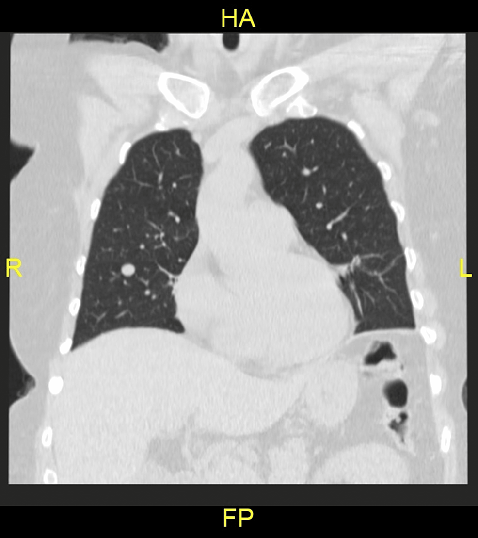 Chest-CT-findings-of-a-56-year-old-female-patient:-coronal-non-contrast-CT-section-