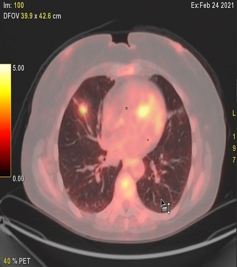 Chest-PET-CT-findings-of-a-56-year-old-female-patient:-axial-PET-CT-section-through-lung-base