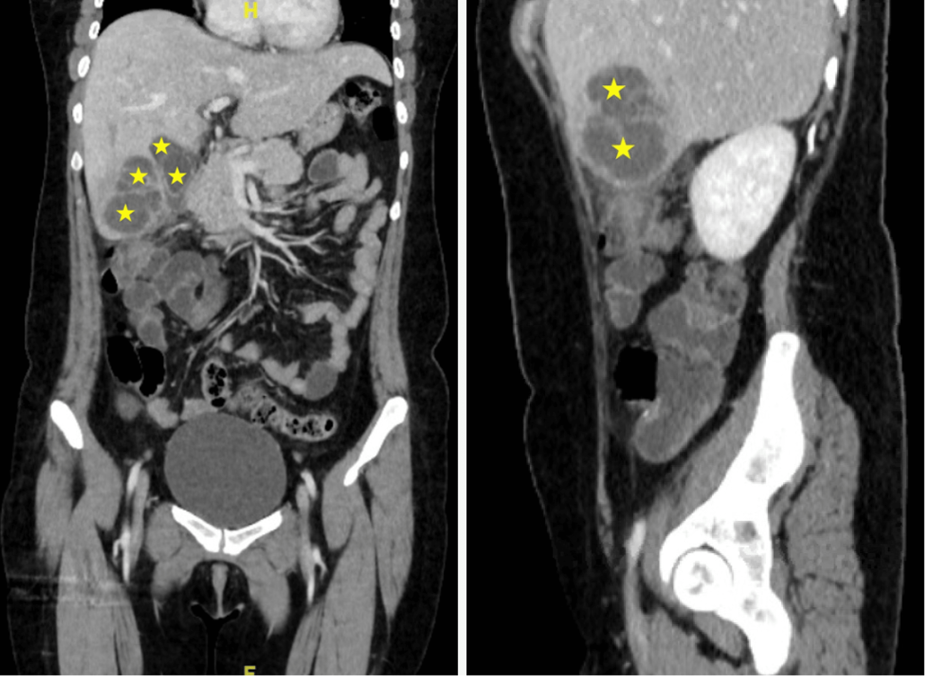 Cureus | Hepatic Abscess Following Acute Appendicitis