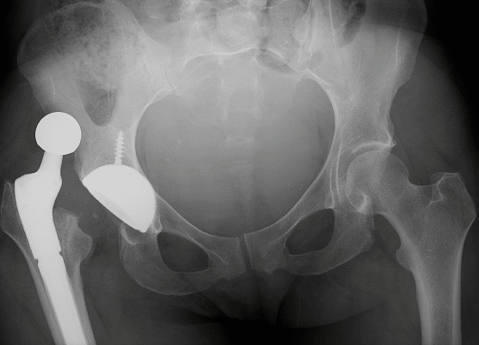 Cureus | A Missed Diagnosis of Intraprosthetic Dislocation in a Dual ...