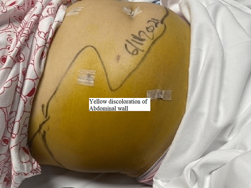 The-torso-of-the-patient-with-yellow-demarcated-discoloration-at-the-right-flank-that-extends-below-the-right-costal-margin-down-to-the-genitalia-and-right-upper-lateral-thigh