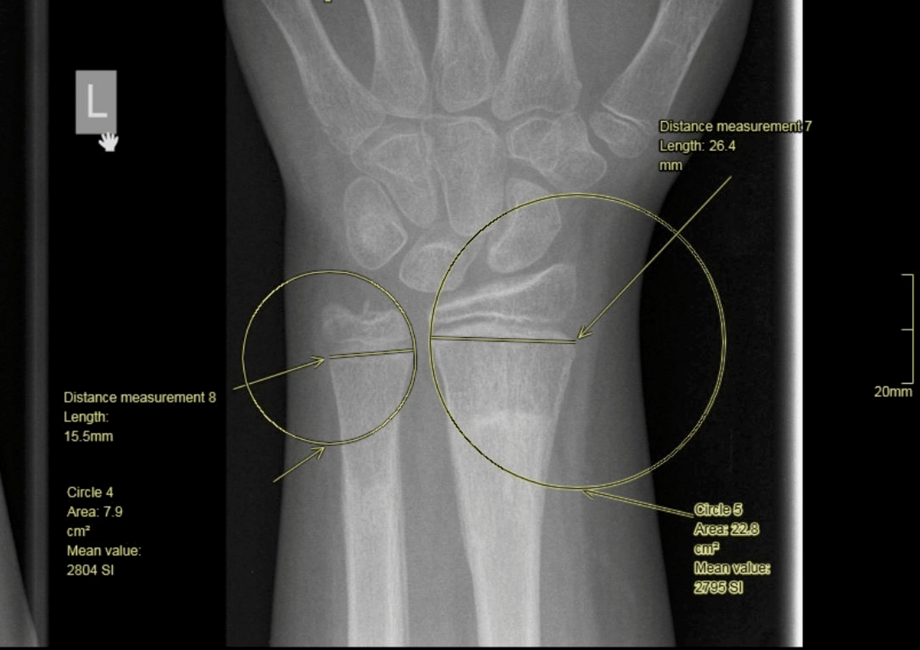 Cureus | The Golden Ratio in Pediatric Wrist Anatomy: A Divine Symmetry