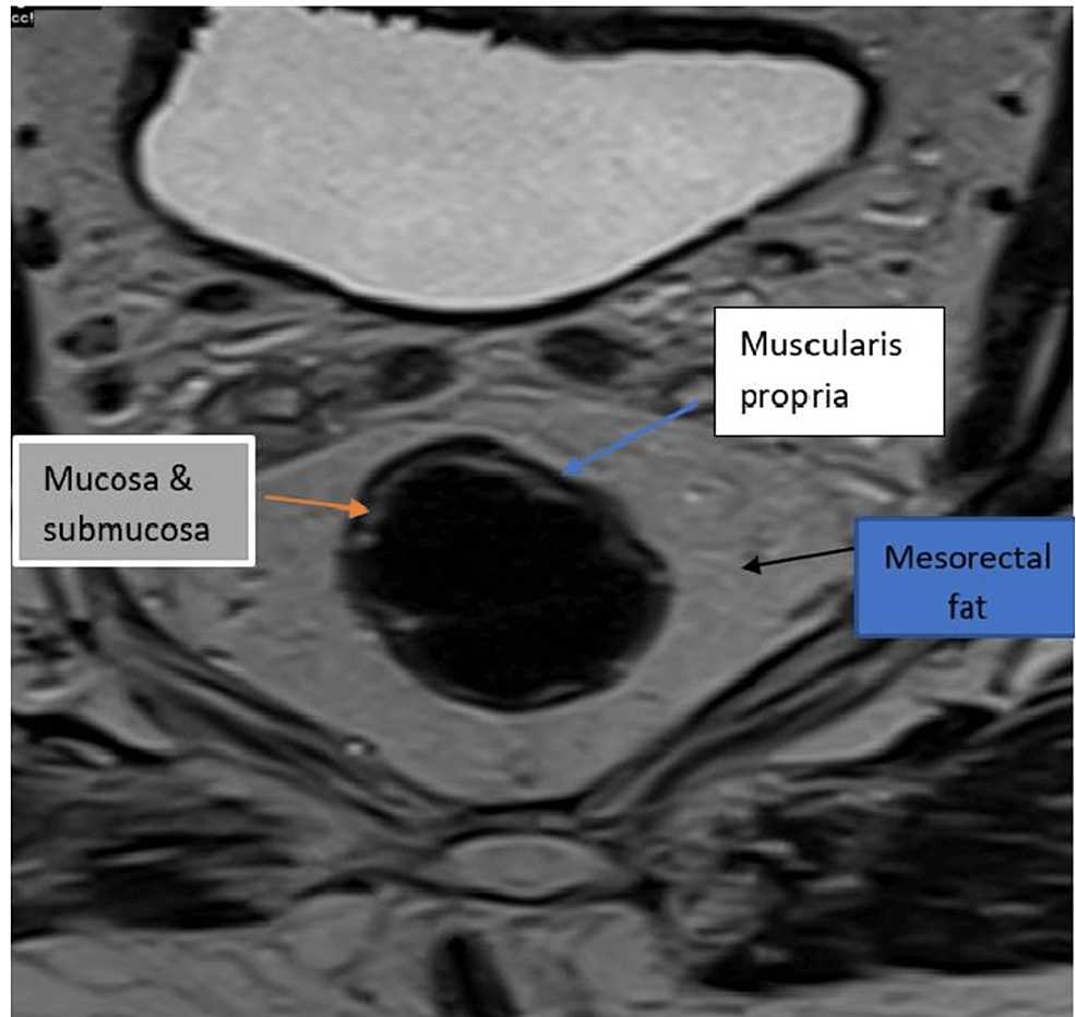 Axial-T2-weighted-MRI-image-of-the-rectum-showing-the-rectal-wall-and-surrounding-mesorectum