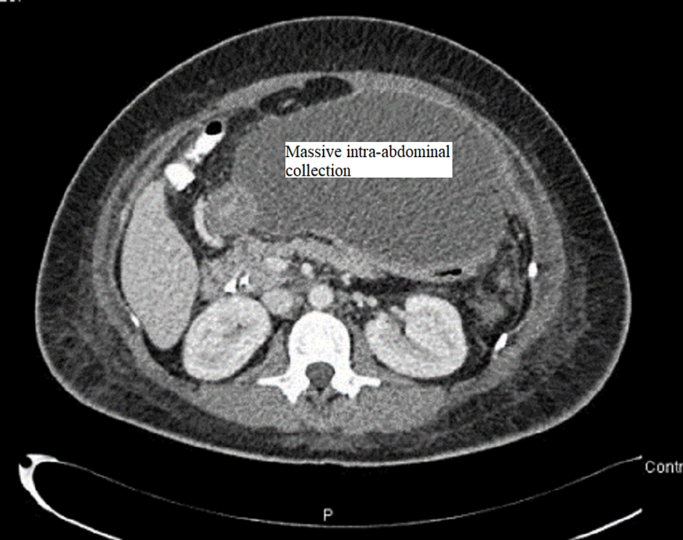 CT-abdomen-and-pelvis-with-contrast-showing-the-free-fluid-collection-in-the-upper-abdomen