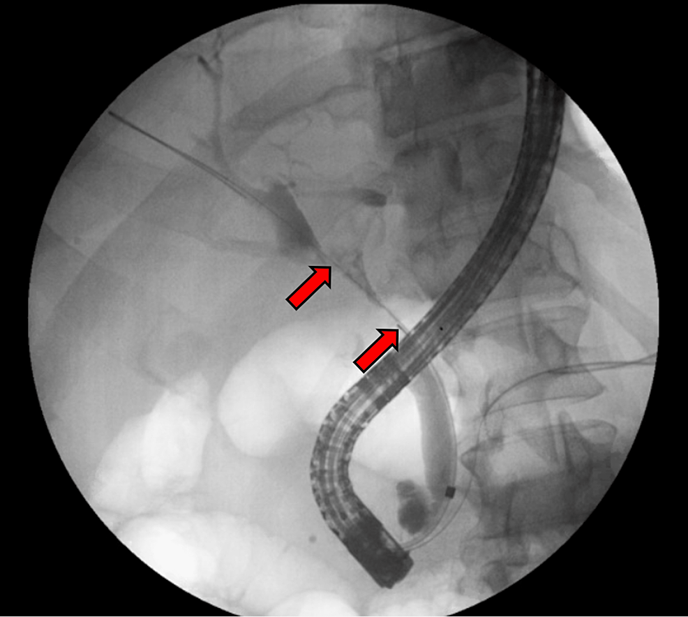 Biliary Intraepithelial Neoplasia With Gallbladder Adenoma And Cirrhosis A Case Report Cureus