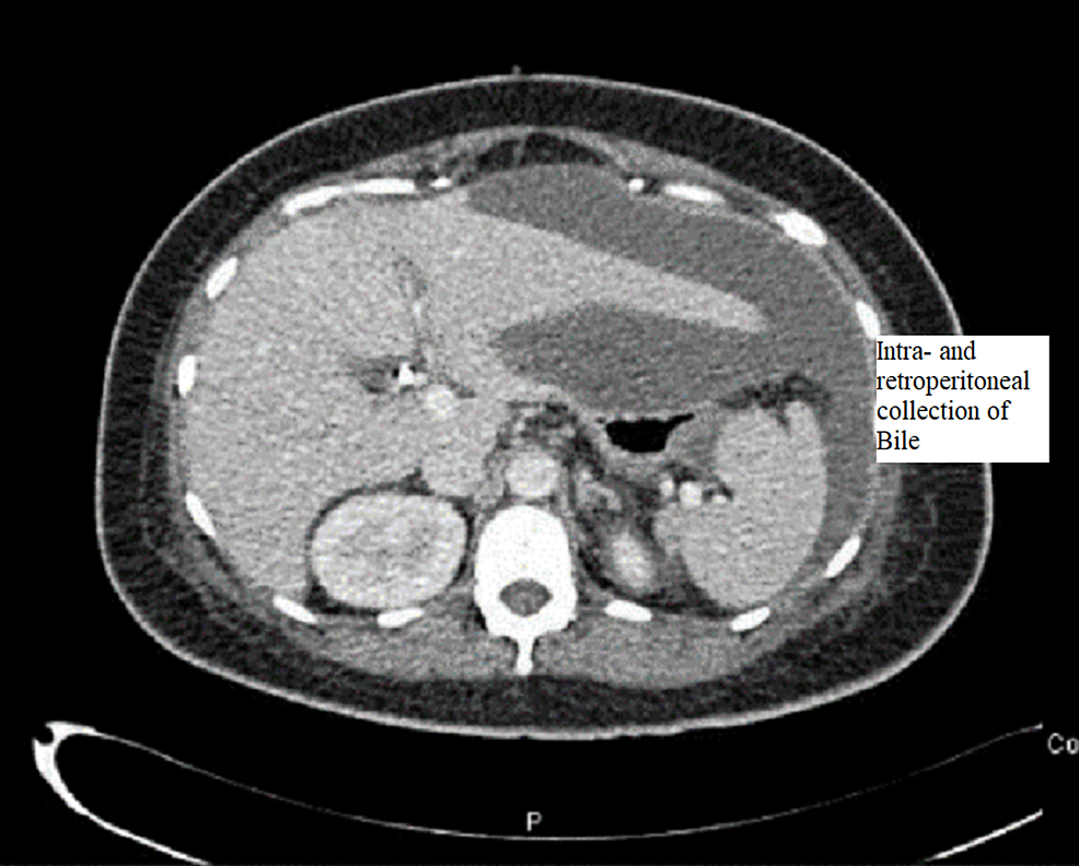 CT-abdomen-and-pelvis-with-contrast-showing-the-free-fluid-collection-in-peri-hepatic-and-peri-splenic-areas