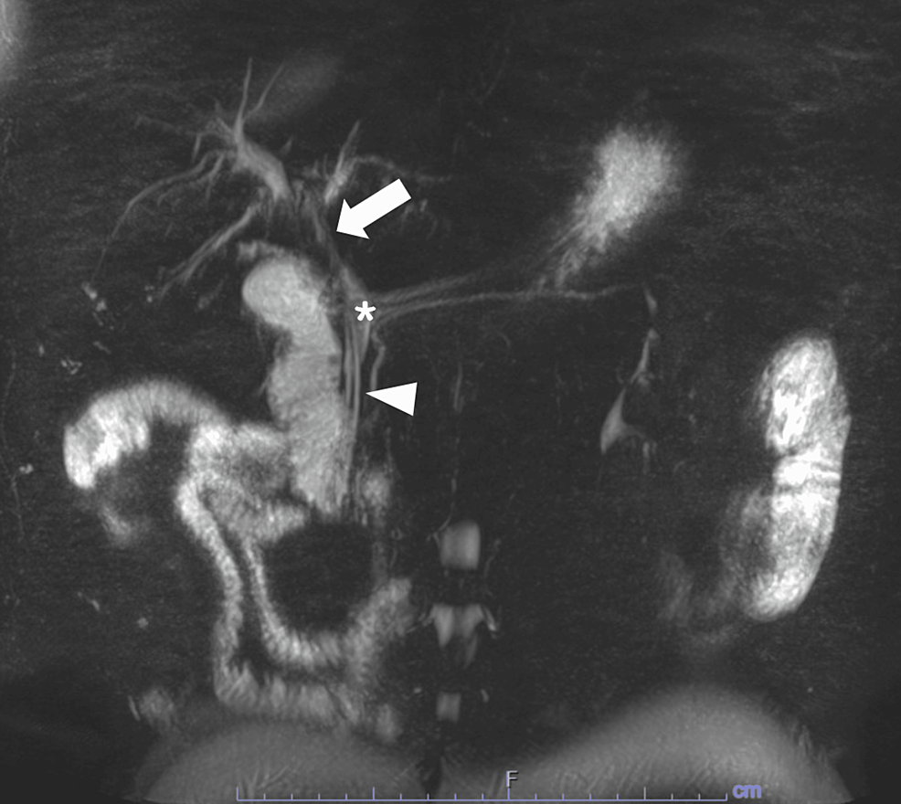 Cureus | Biliary Intraepithelial Neoplasia With Gallbladder Adenoma and ...