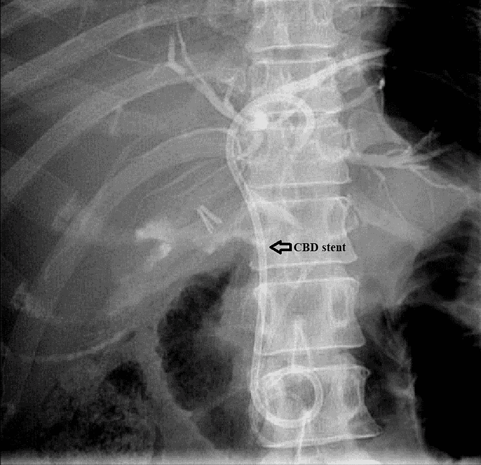 ERCP:-8.5F-5-cm-double-pigtail-plastic-biliary-stent-was-placed-into-the-left-hepatic-duct-with-good-contrast-drainage-in-the-duodenum