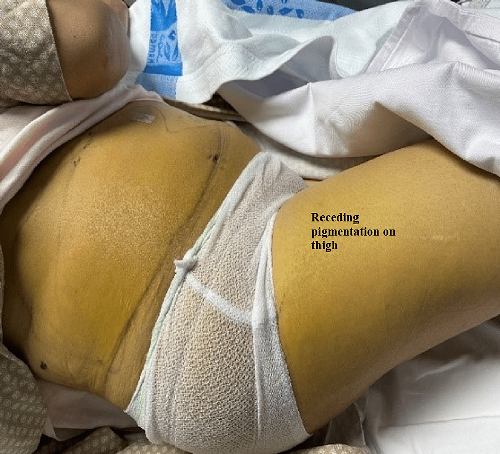 Vanishing-demarcated-edges-of-jaundice-after-ERCP-and-stenting-(lateral-view)