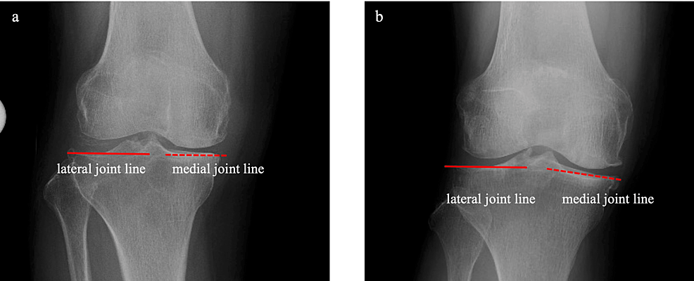 Kinematic Alignment Bi-unicompartmental Knee Arthroplasty With Oxford Partial Knees: A Technical Note