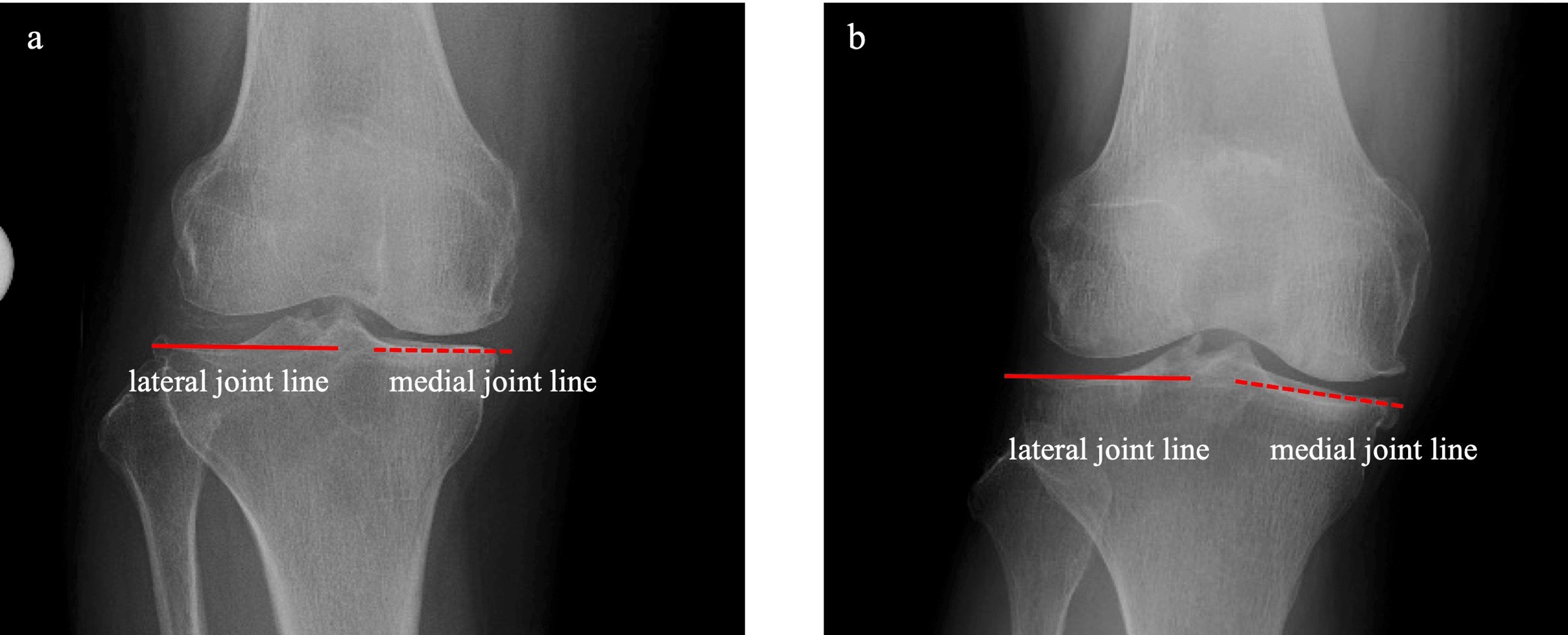 Cureus Kinematic Alignment Knee Arthroplasty With