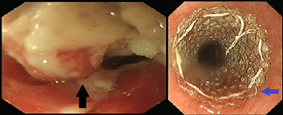OGD:-esófago-medio-inferior-(flecha-negra),-tratamiento-con-un-stent-metálico-autoexpandible-cubierto-(flecha-azul)