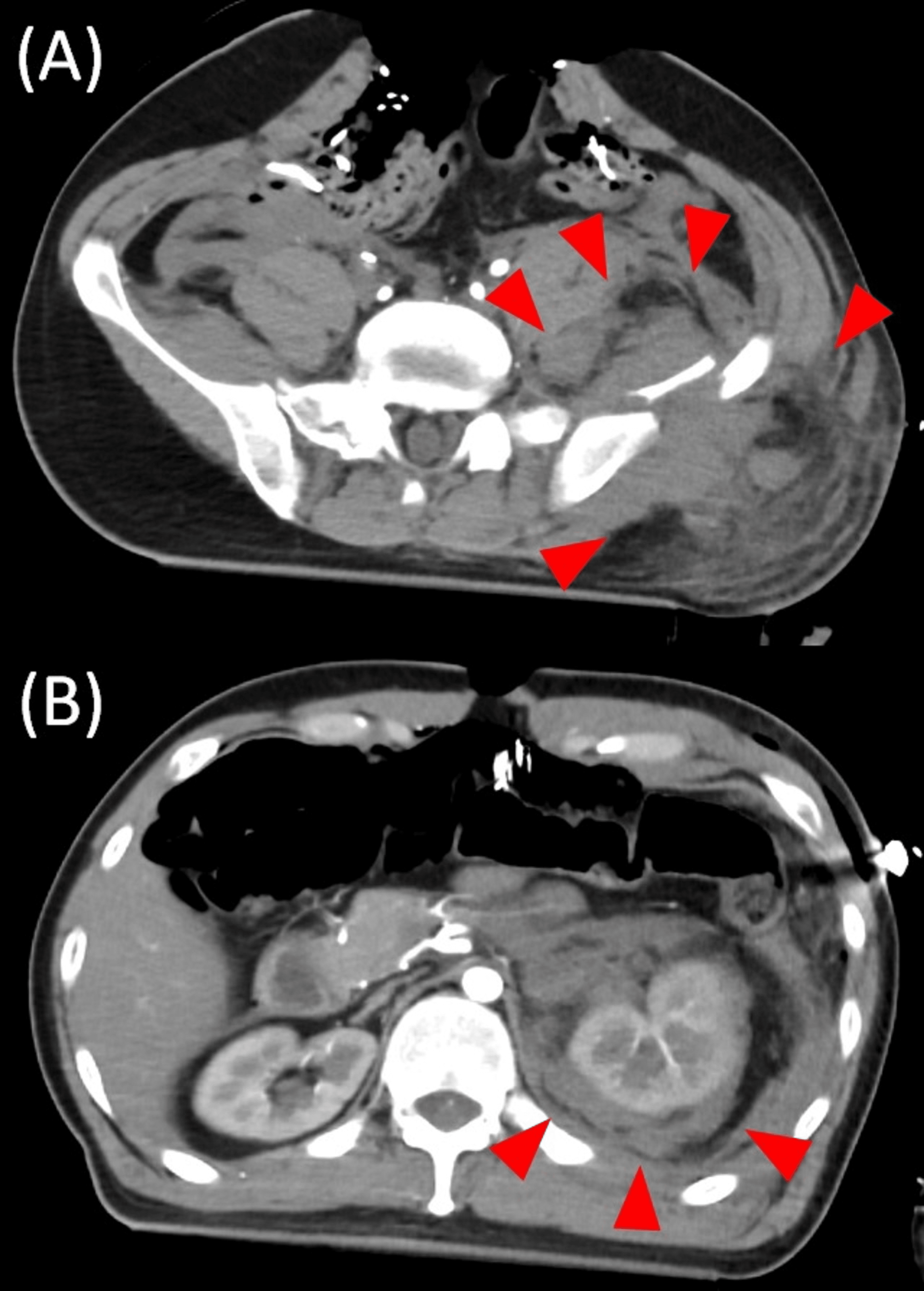 Cureus Intraperitoneal Rupture of the Urinary Bladder Mimics an Intra