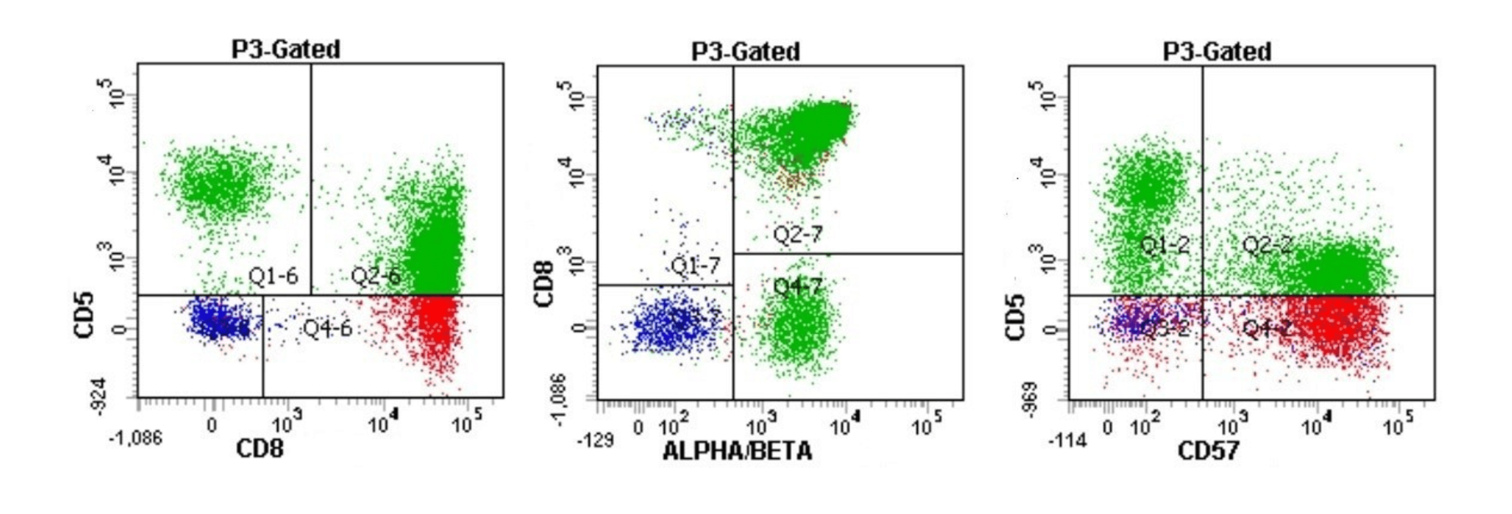 Cureus | Unusual Presentation of T-cell Large Granular Lymphocytic Leukemia