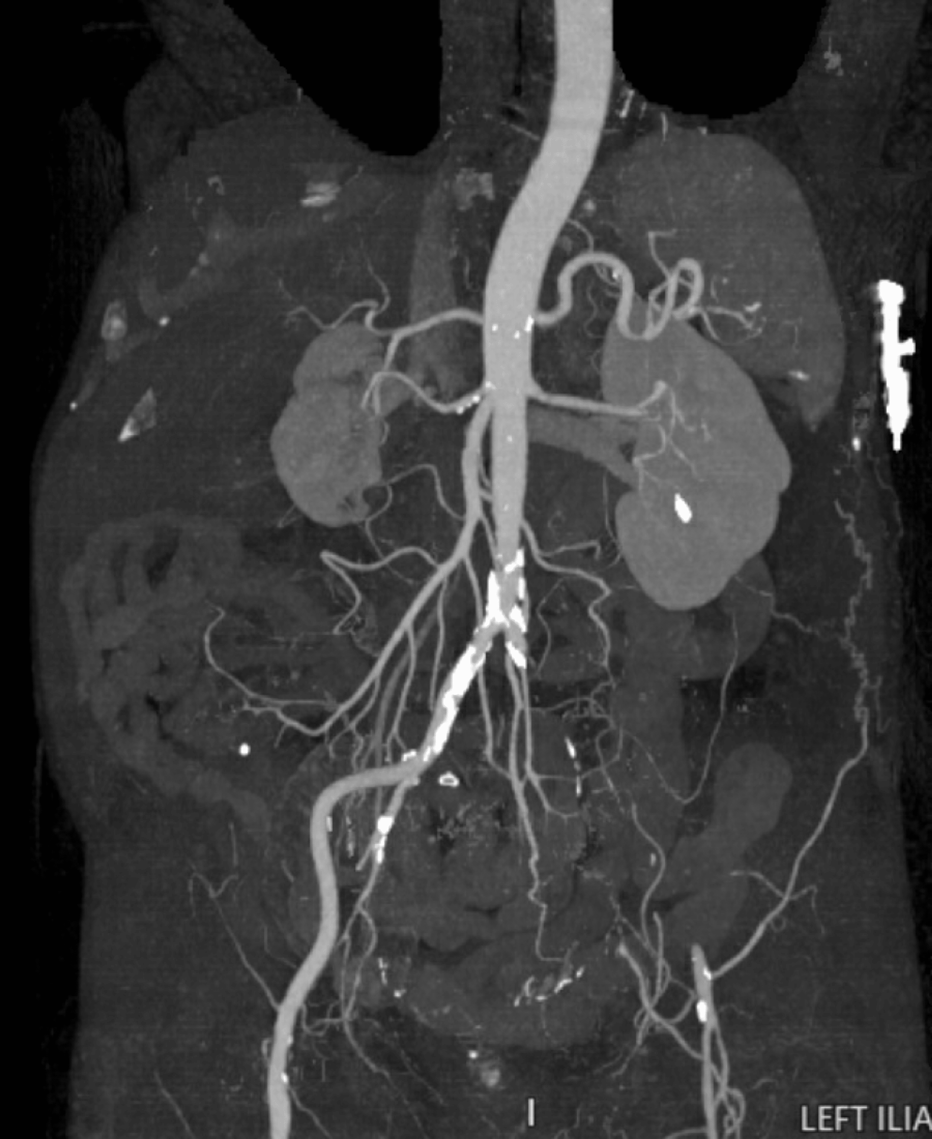 Cureus | Arterial Occlusion and Acute Deep Vein Thrombosis-Induced ...