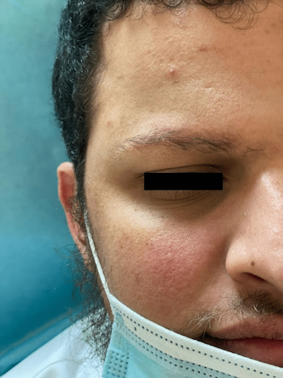 follicular hyperkeratosis face