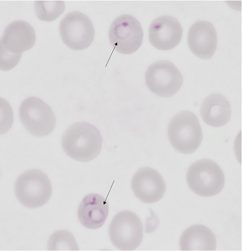 Malaria-2: Plasmodium falciparum stages - YouTube