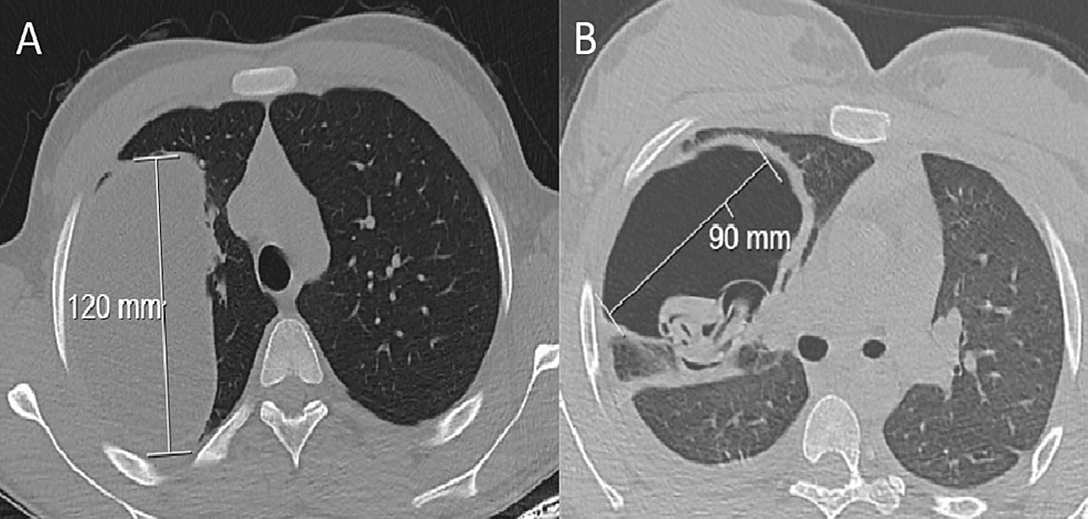 CT-image-of-ruptured-and-non-ruptured-pulmonary-cysts