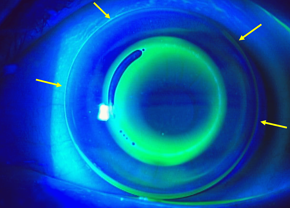 Lens-fitting-showing-fluorescein-pattern.-It-showed-too-steep-lens-fitting,-especially-the-bevel-was-too-narrow-(arrows).