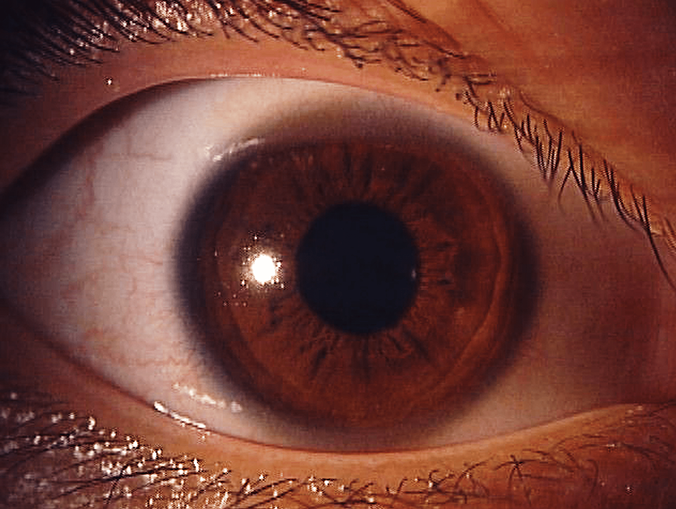 Ocular-findings-after-treatment-with-acyclovir-eye-ointment.-All-findings-disappeared-in-the-left-eye.