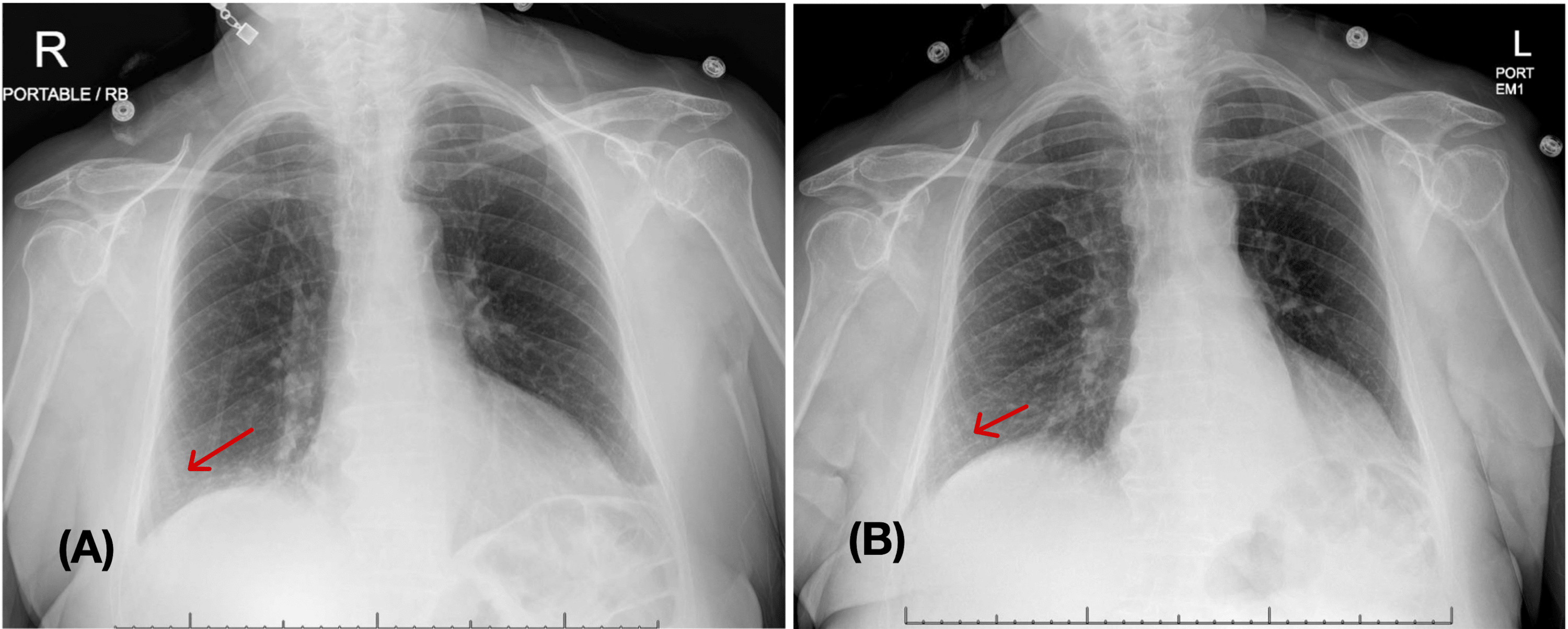 Cureus | Parainfluenza Bronchiolitis Mimicking Recurrent Lobar Pneumonia