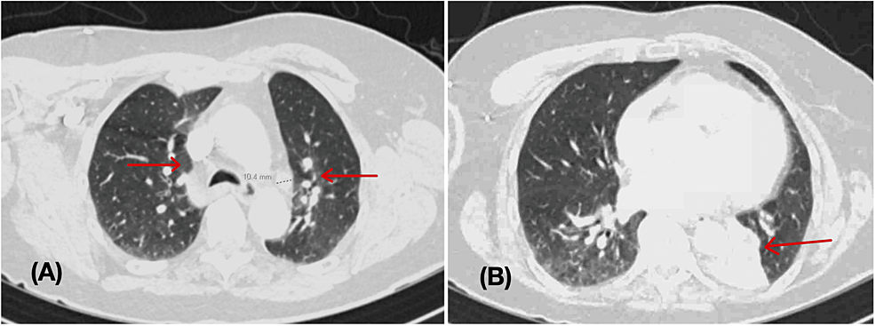 -CT-pulmonary-angiogram-