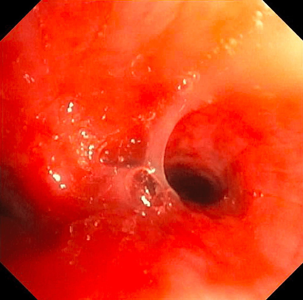 Bronchoscopy