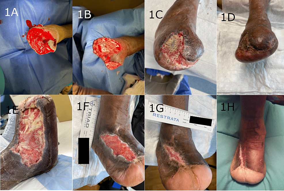 Examples-of-two-transmetatarsal-amputation-wounds-demonstrating-progressive-healing-and-complete-closure-following-treatment-with-the-synthetic-hybrid-scale-fiber-matrix.