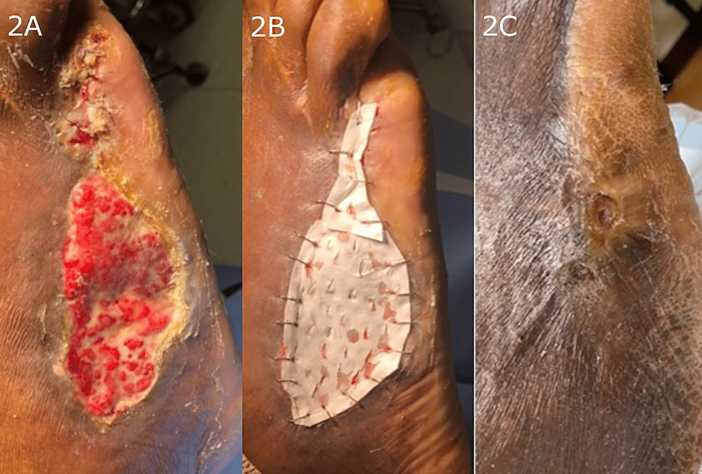Example-of-metatarsal/partial-ray-amputation-wound-demonstrating-progressive-healing-and-complete-closure-following-treatment-with-the-hybrid-scale-fiber-matrix.