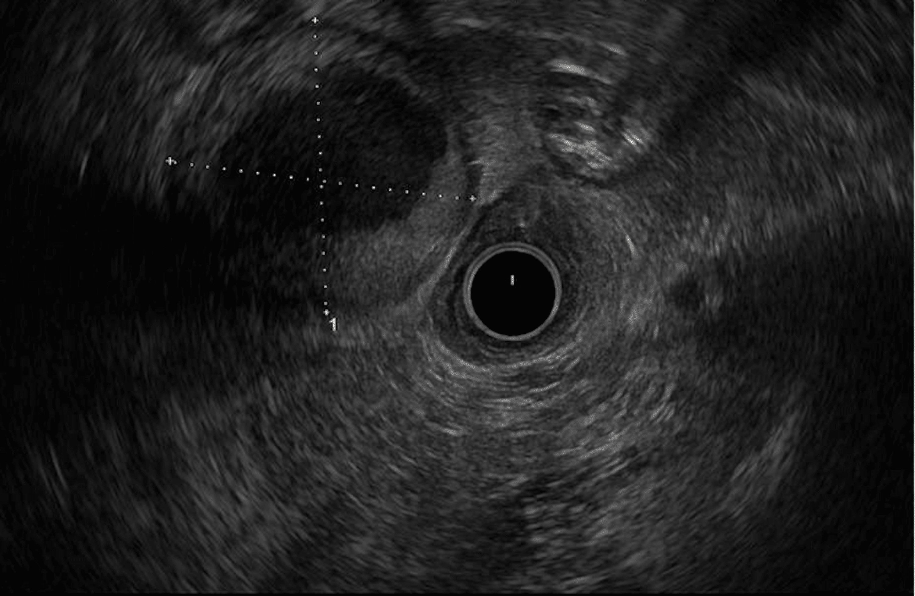 Cureus Not Your Typical Cyst A Periduodenal Chylous Cyst Diagnosed