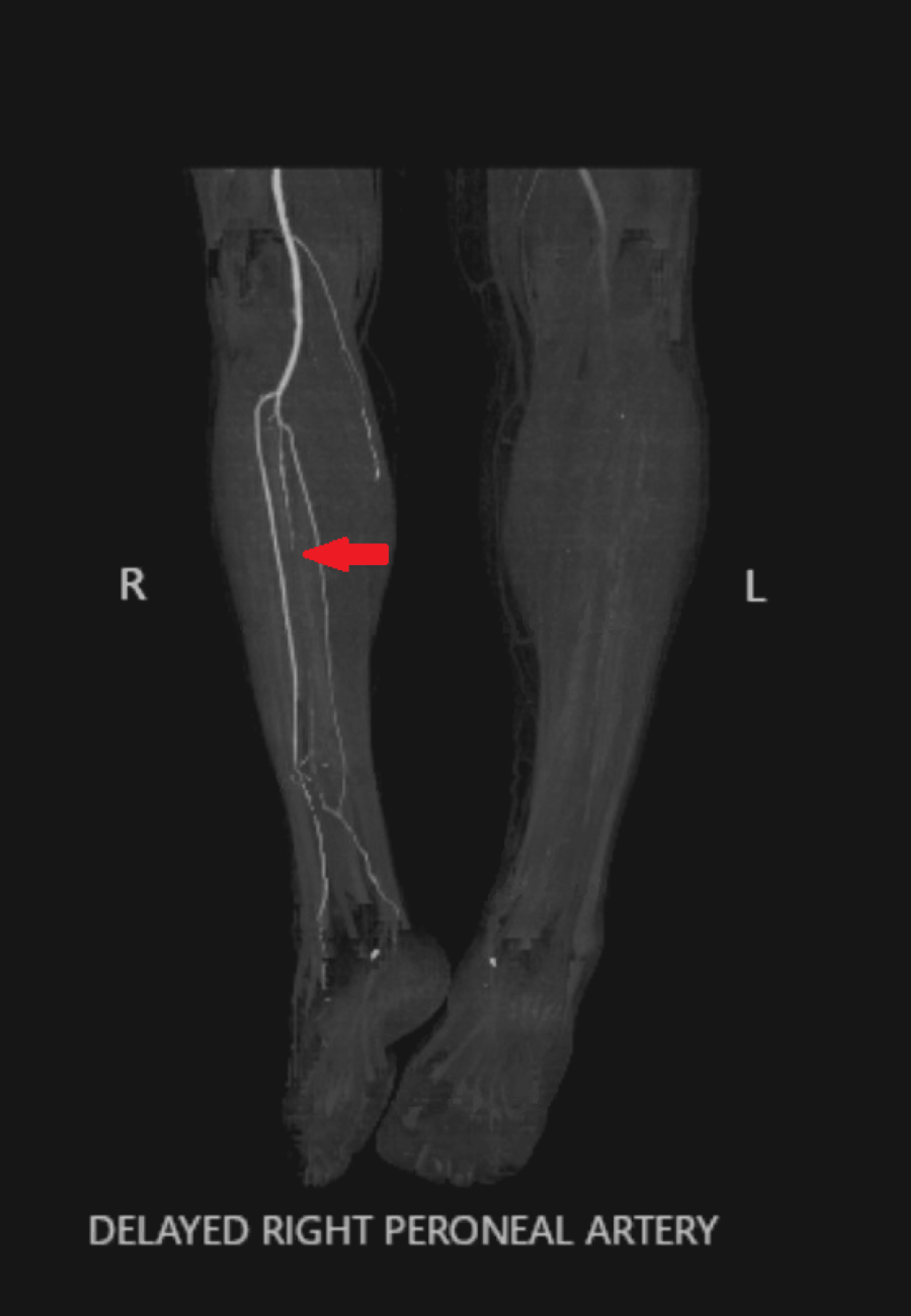 Cureus Arterial Occlusion and Acute Deep Vein ThrombosisInduced