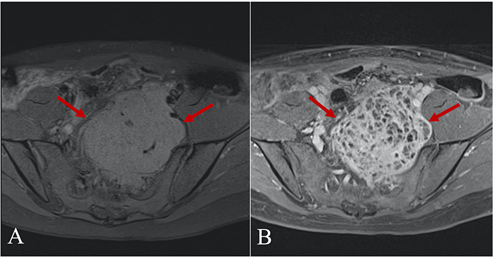 T1-weighted-fat-saturated-axial-(A)-and-contrast-enhanced-axial-(B)-MRI-images.-Huge-sacral-and-presacral-heterogeneous-intermediate-signal-intensity-tumor-showing-an-avid-post-contrast-enhancement-(arrows).-No-signs-of-infiltration-to-adjacent-soft-tissues-can-be-seen.