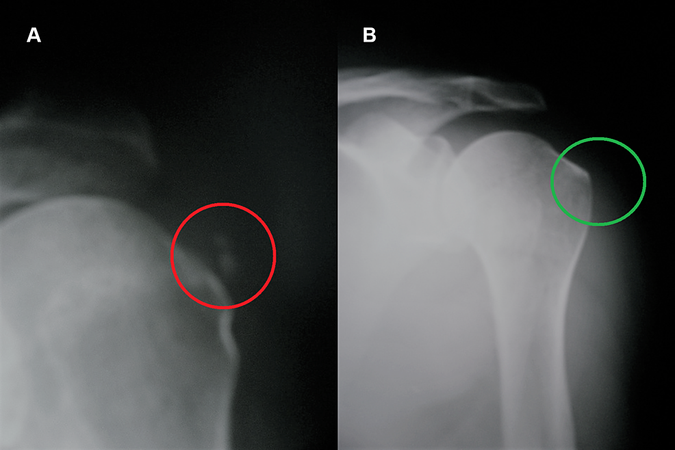 What Is Considered A Large Breast Tumor