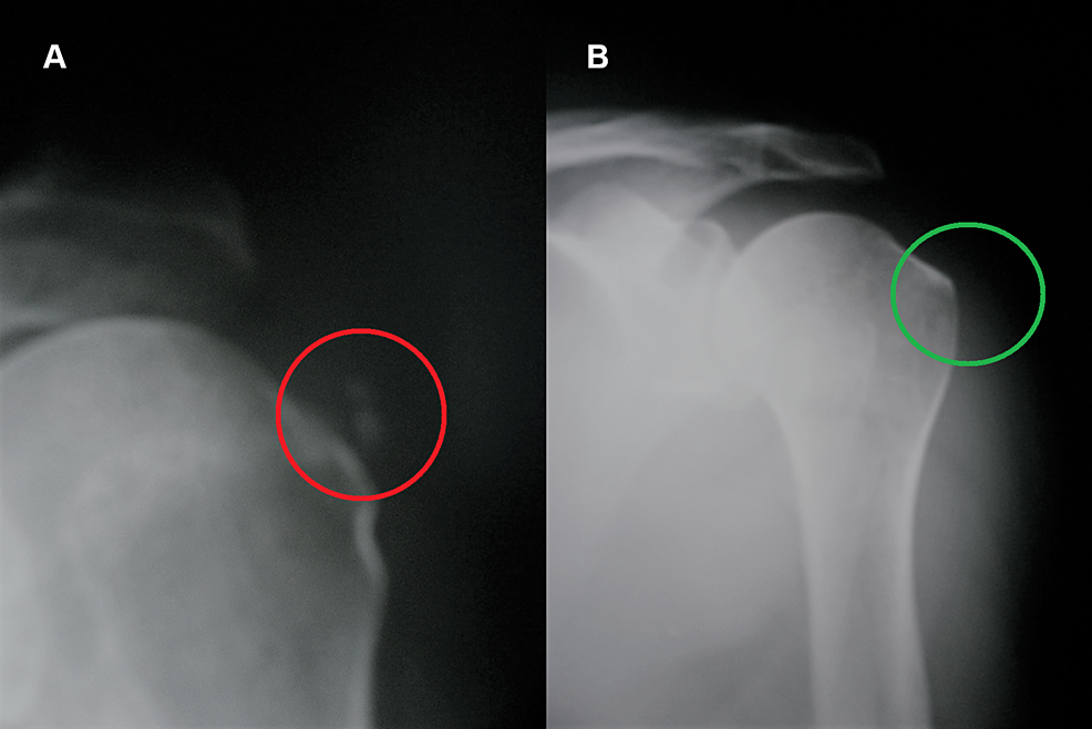 Cureus Calcific Tendinitis Of The Shoulder A Neuro Psychomotor 