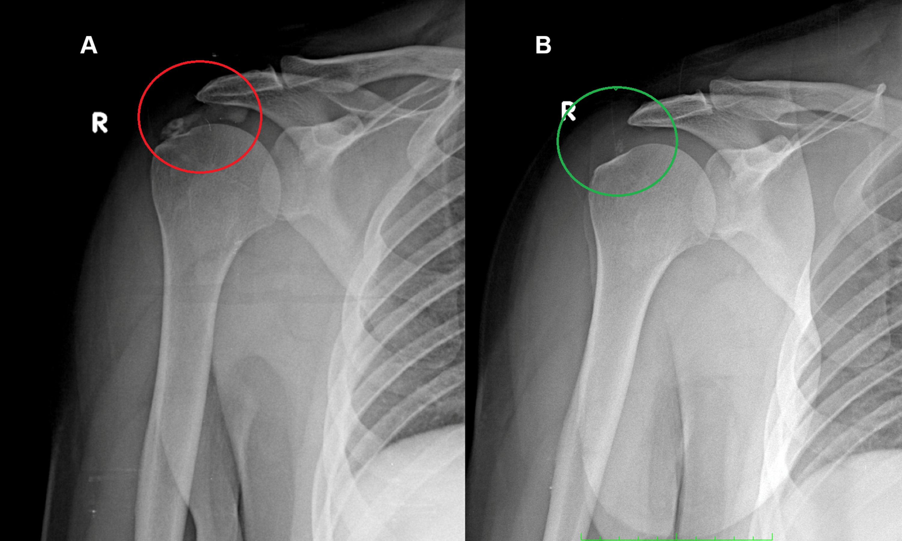 Shoulder Calcification