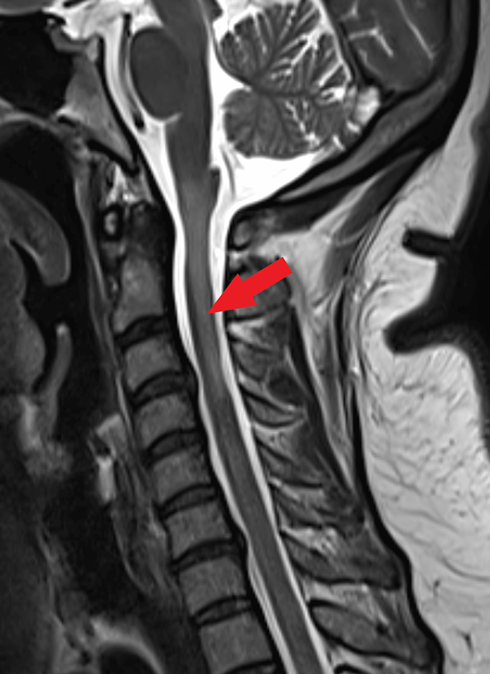 Cureus, Myelitis Following COVID-19 Illness